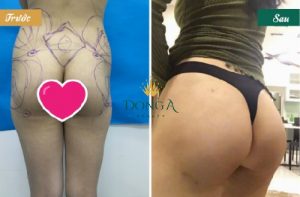 Hình ảnh trước – sau phẫu thuật nâng mông