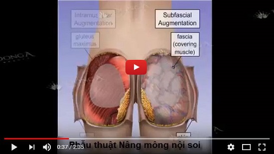 Phẫu thuật nâng mông nội soi [video mô phỏng 3D]