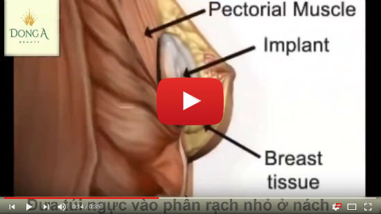 Nâng ngực qua đường nách (video mô phỏng 3D)