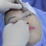 Phẫu thuật cắt mí Dr.Park
