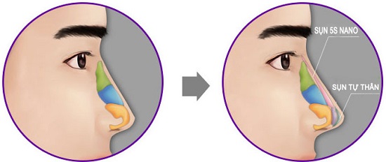 Nâng mũi Sline Dr.Park sử dụng kết hợp chất liệu sụn tự thân và chất liệu 5S Nano