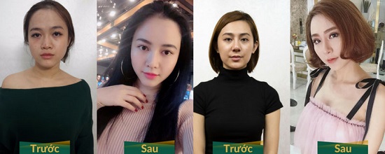 Hình ảnh trước và sau khi nâng mũi của Võ Bạch Tuyết và Thu Trang