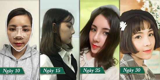 Hình ảnh trước và sau khi nâng mũi Sline Dr Park của cô gái “mũi heo” Hoàng Thị Phượng