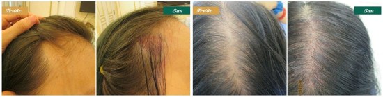 Kết quả trị rụng tóc hói đầu bằng kỹ thuật cấy tóc